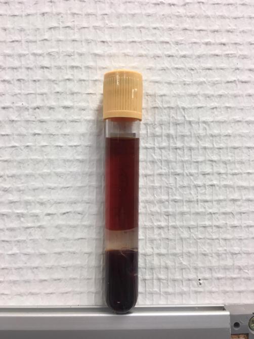 Bruinrood bloedserum door hemolyse en methemoglobinevorming. De bloedcellen (onder) zijn ook donker verkleurd.